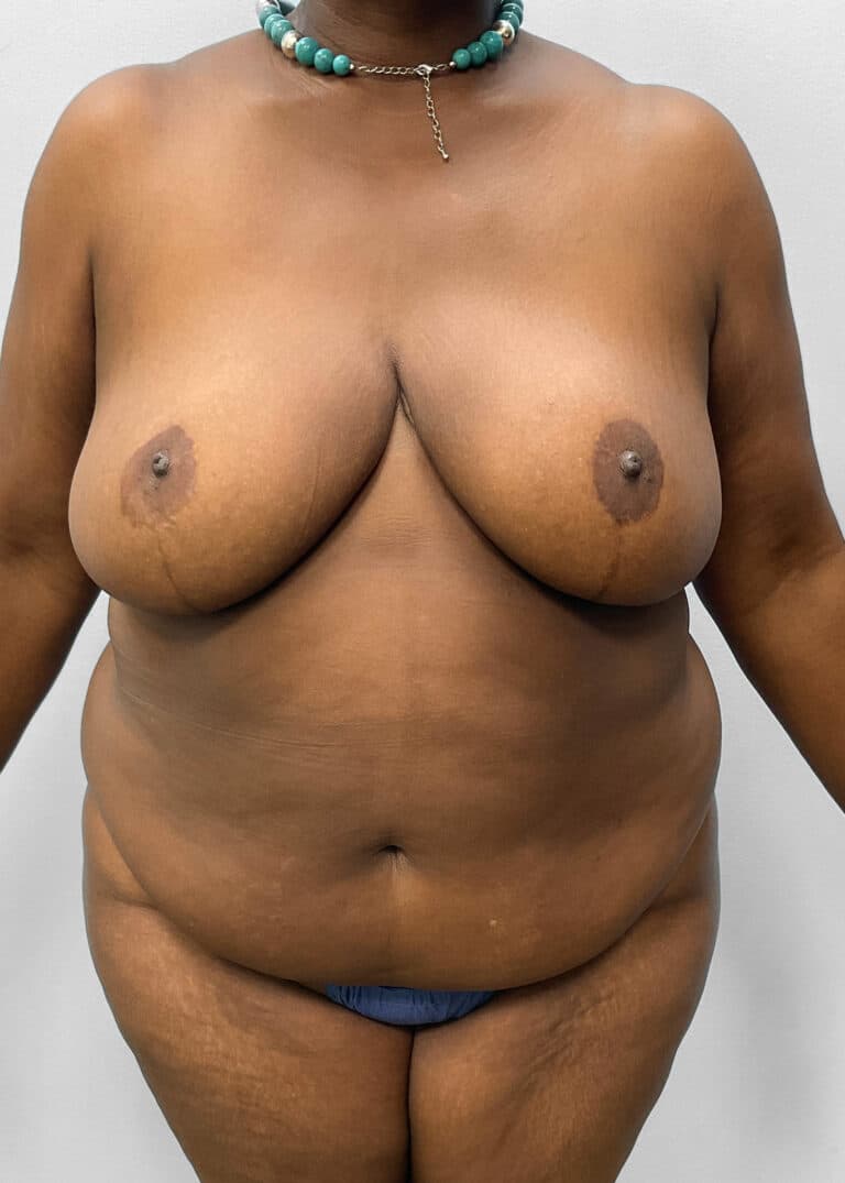 Before Image: Tummy Tuck & Lipo- Dr. Tucker - front