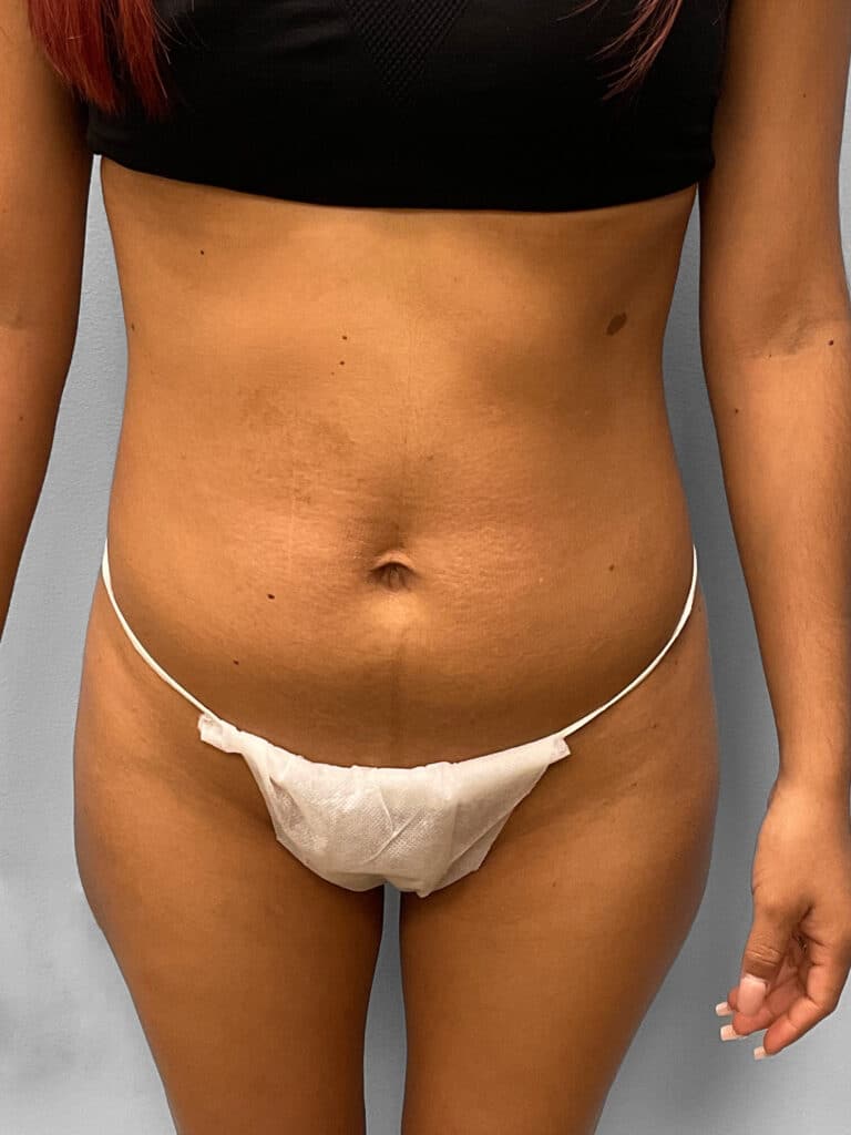 Before Image: Tummy Tuck, Lipo, & BBL- Dr. Tucker - front