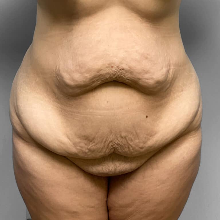 Before Image: Tummy Tuck & Lipo- Dr. Howell - front