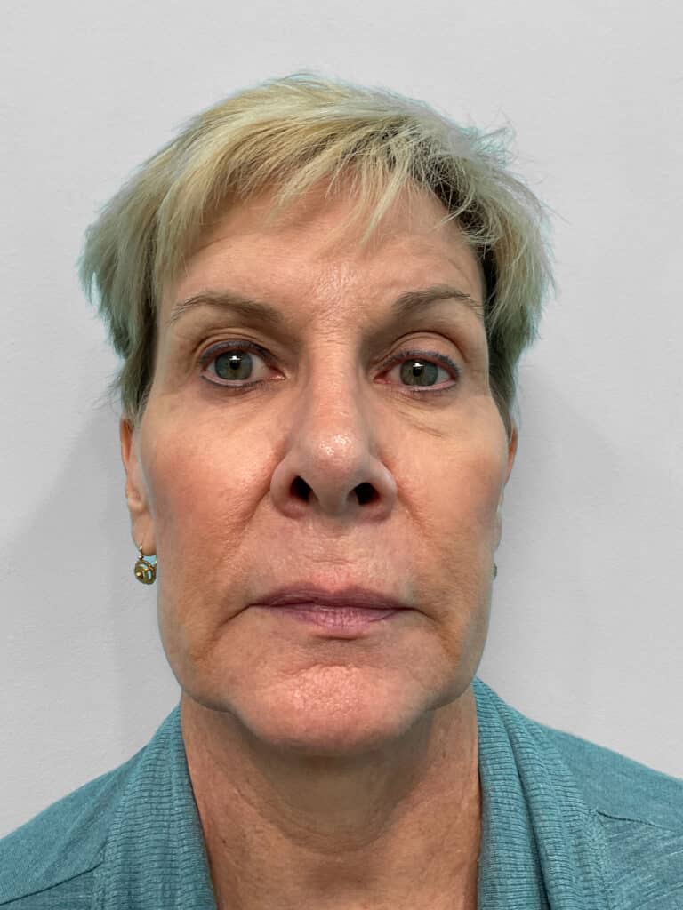 Before Image: Juvederm Volbella- Heather - front