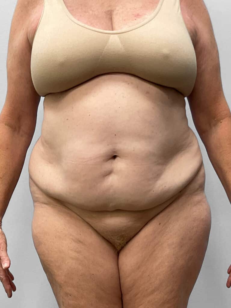 Before Image: Abdominoplasty & Lipo- Dr. Howell - front
