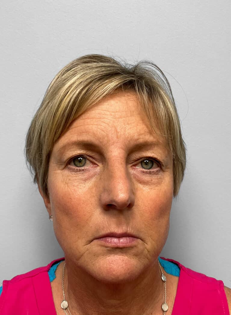 Before Image: Blepharoplasty & Laser Resurfacing- Dr. Howell - front