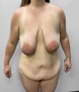Before Image: Mommy Makeover- Dr. Howell