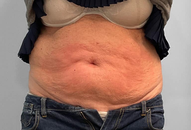 Before Image: Emsculpt Neo- Jessica - front