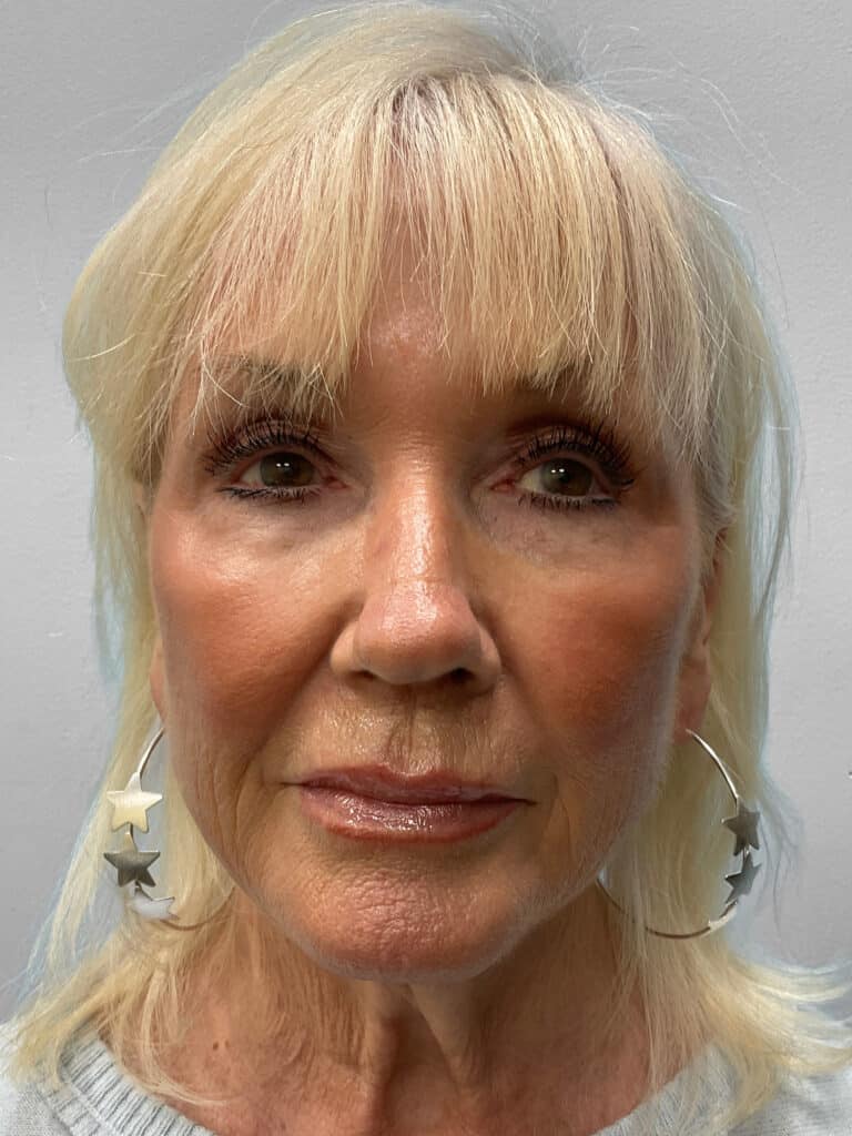 Before Image: Facelift & TFX- Dr. Tucker - front