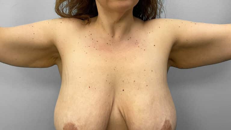 Before Image: Arm Lift- Dr. Tucker - front