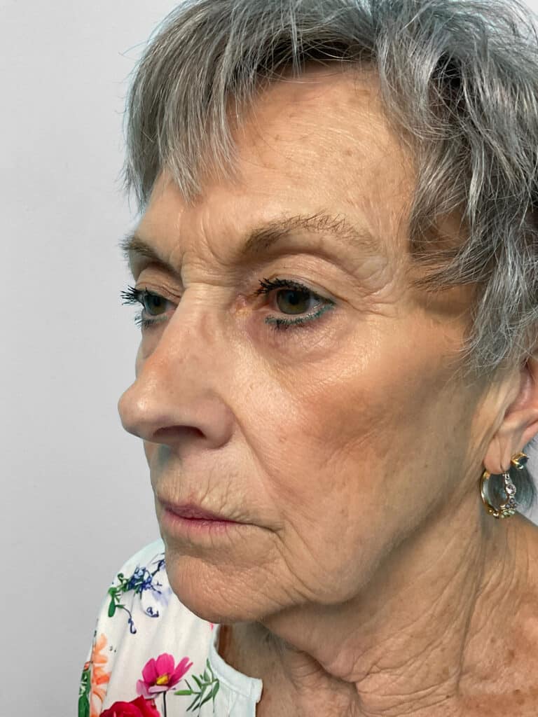 Before Image: Botox & Restylane Kysse- Heather - left-front-oblique