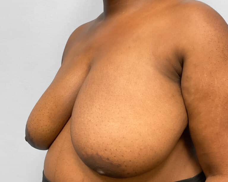 Before Image: Breast Reduction- Dr. Tucker - left-front-oblique