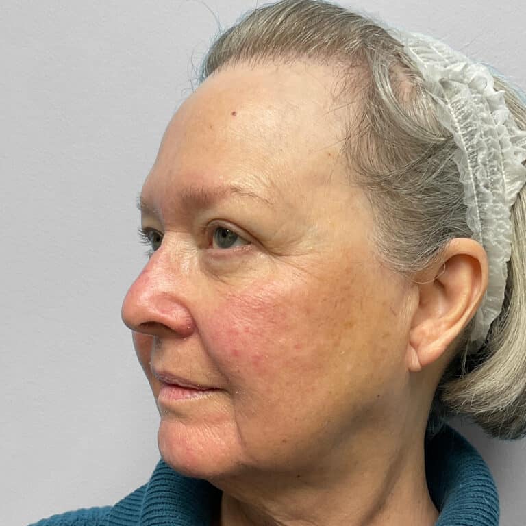 Before Image: Facelift & TFX- Dr. Tucker - left-front-oblique