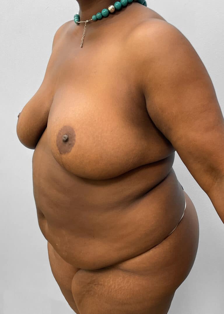 Before Image: Tummy Tuck & Lipo- Dr. Tucker - left-front-oblique