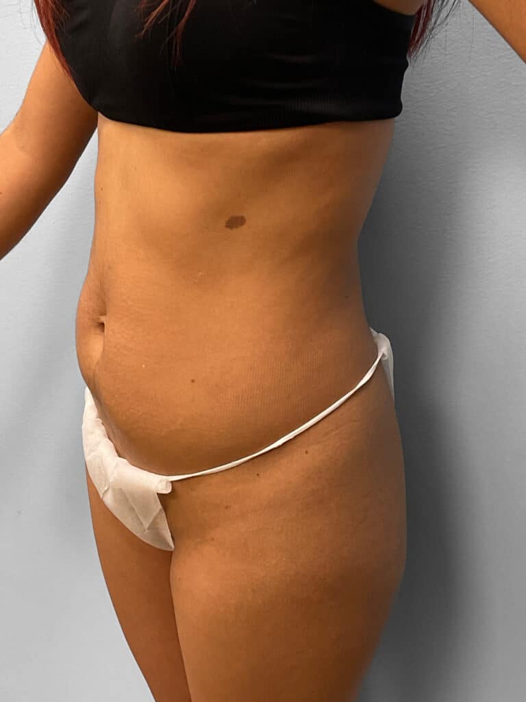 Before Image: Tummy Tuck, Lipo, & BBL- Dr. Tucker - left-front-oblique