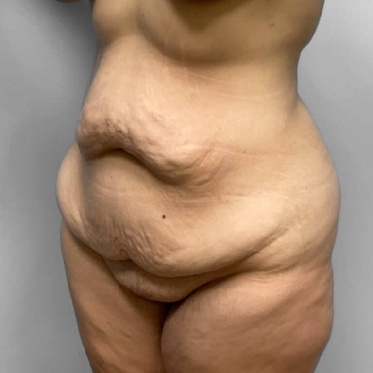 Before Image: Tummy Tuck & Lipo- Dr. Howell - left-front-oblique