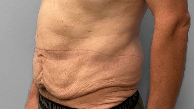 Before Image: Body Lift- Dr. Tucker - left-front-oblique