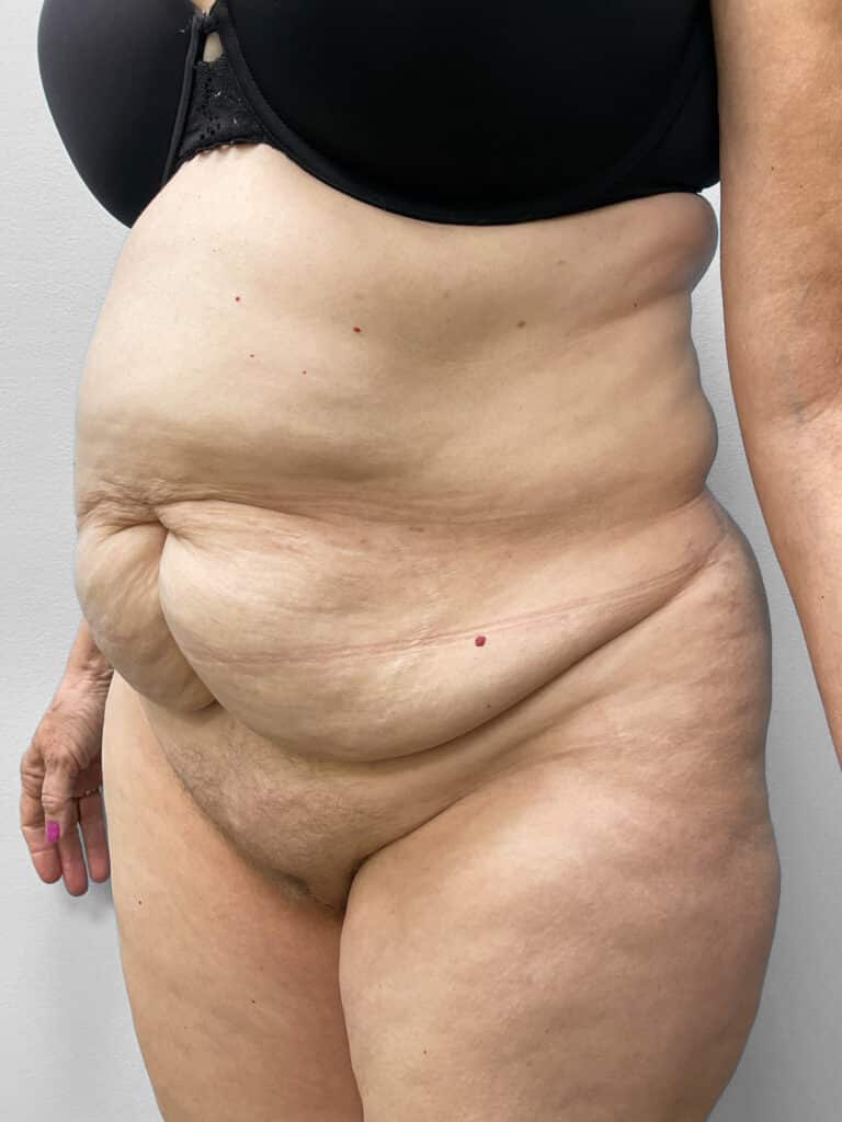 Before Image: Tummy Tuck & Liposuction- Dr. Tucker - left-front-oblique