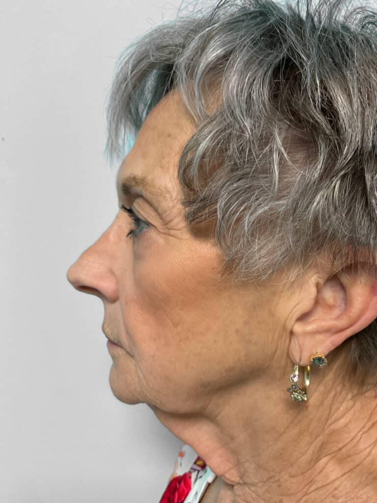 Before Image: Botox & Restylane Kysse- Heather - left-side