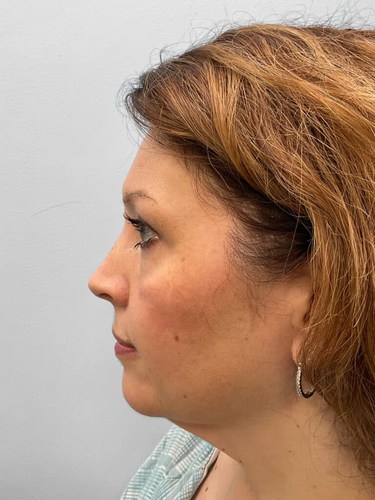 Before Image: Facelift- Dr. Tucker - left-side