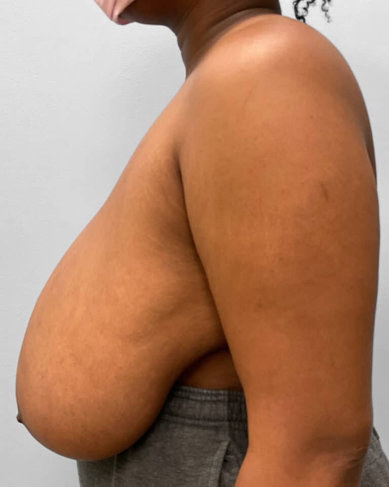 Before Image: Breast Reduction- Dr. Tucker - left-side