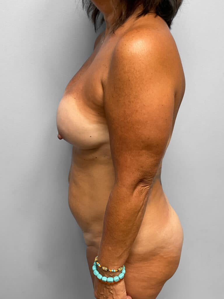 Before Image: Mommy Makeover- Dr. Tucker - left-side
