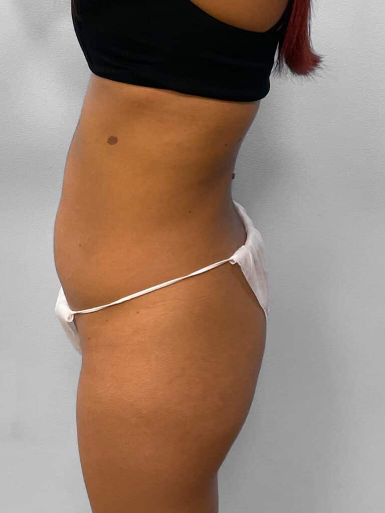 Before Image: Tummy Tuck, Lipo, & BBL- Dr. Tucker - left-side