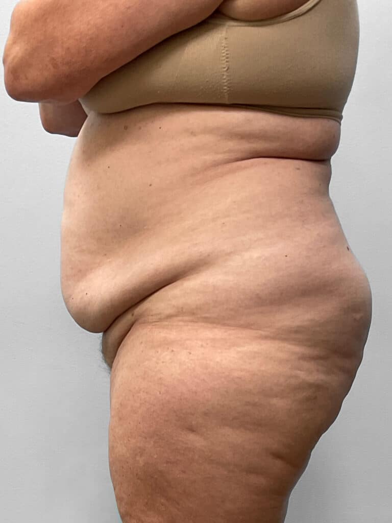 Before Image: Abdominoplasty & Lipo- Dr. Howell - left-side