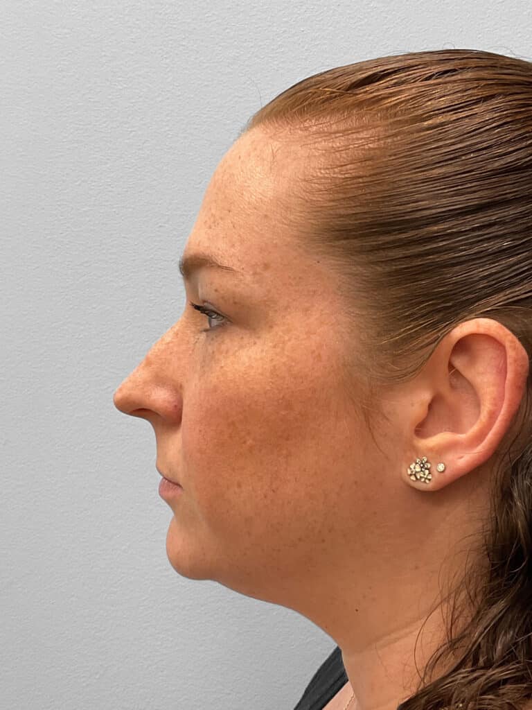 Before Image: Rhinoplasty- Dr. Tucker -