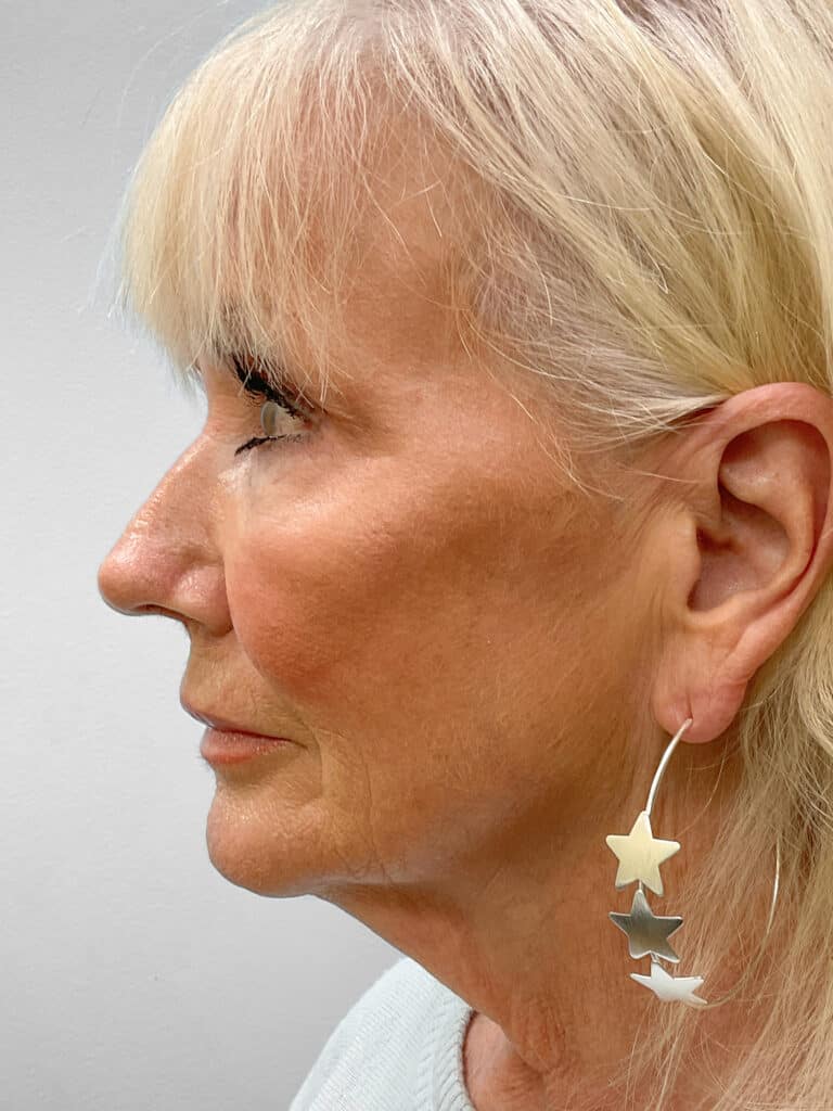 Before Image: Facelift & TFX- Dr. Tucker - left-side
