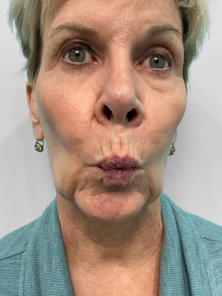 Before Image: Juvederm Volbella- Heather - front