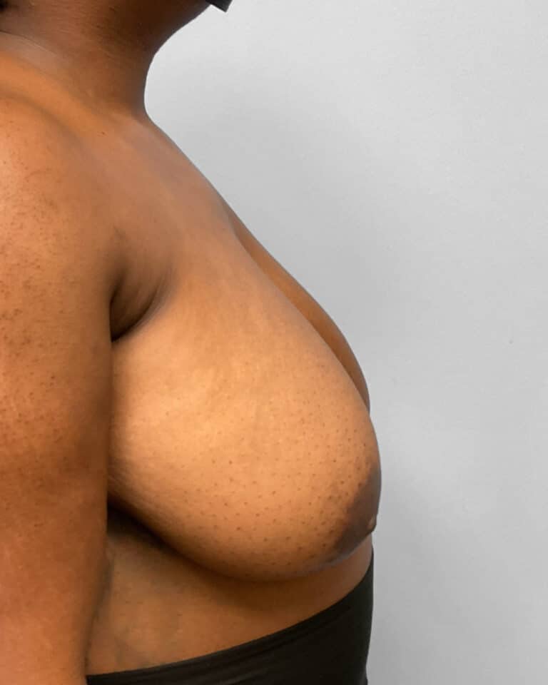 Before Image: Breast Reduction- Dr. Tucker -