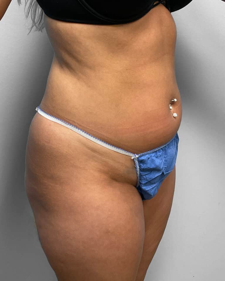 Before Image: BBL & Liposuction- Dr. Howell - right-front-oblique