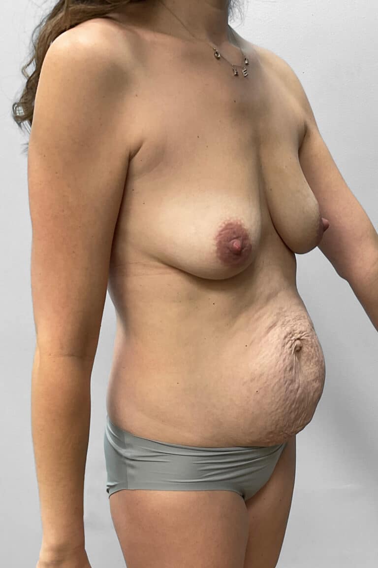 Before Image: Mommy Makeover- Dr. Tucker - right-front-oblique