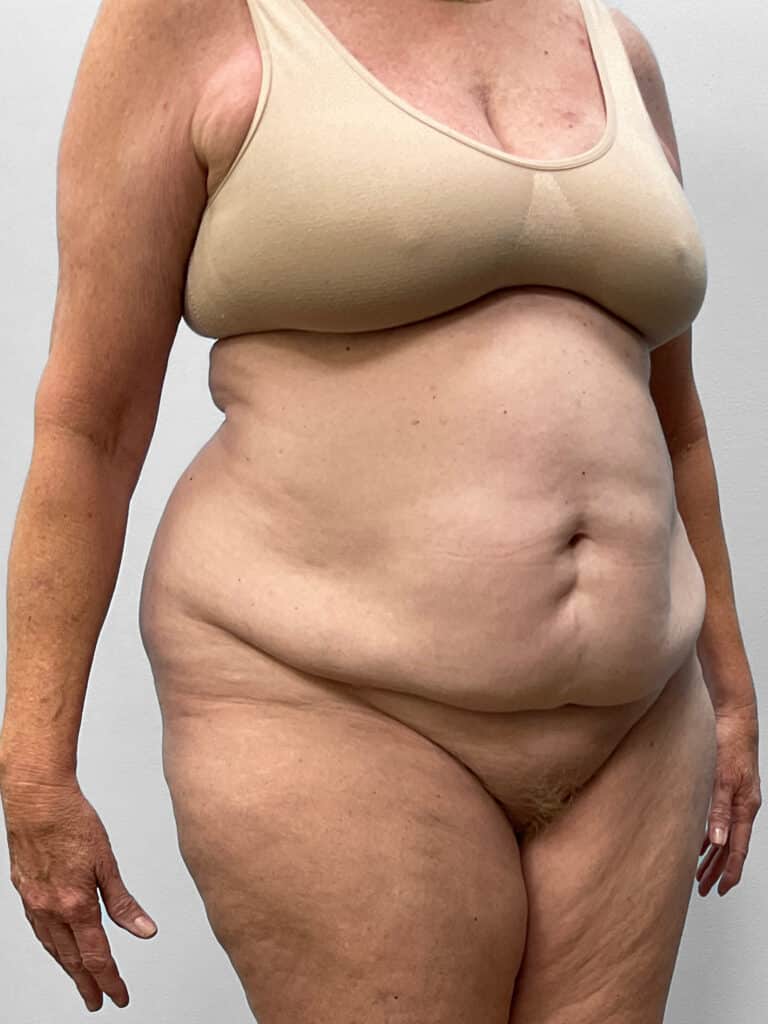 Before Image: Abdominoplasty & Lipo- Dr. Howell - right-front-oblique