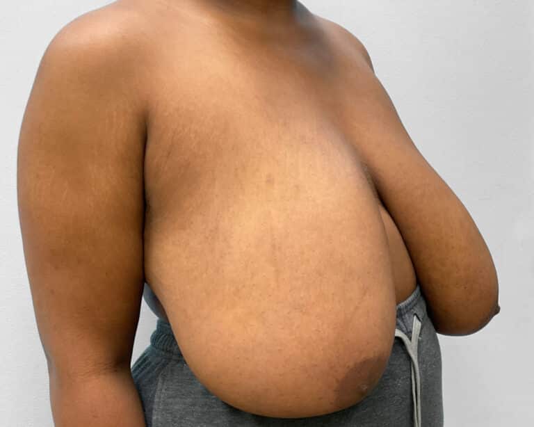 Before Image: Breast Reduction- Dr. Tucker - right-front-oblique