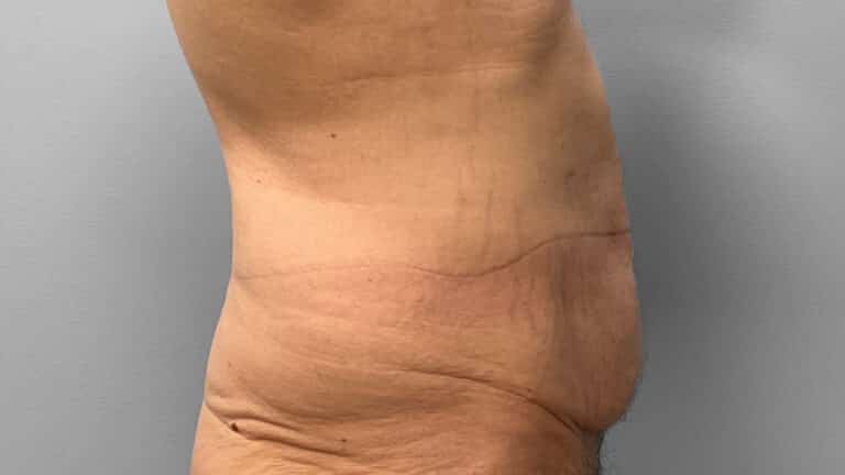 Before Image: Body Lift- Dr. Tucker - right-side