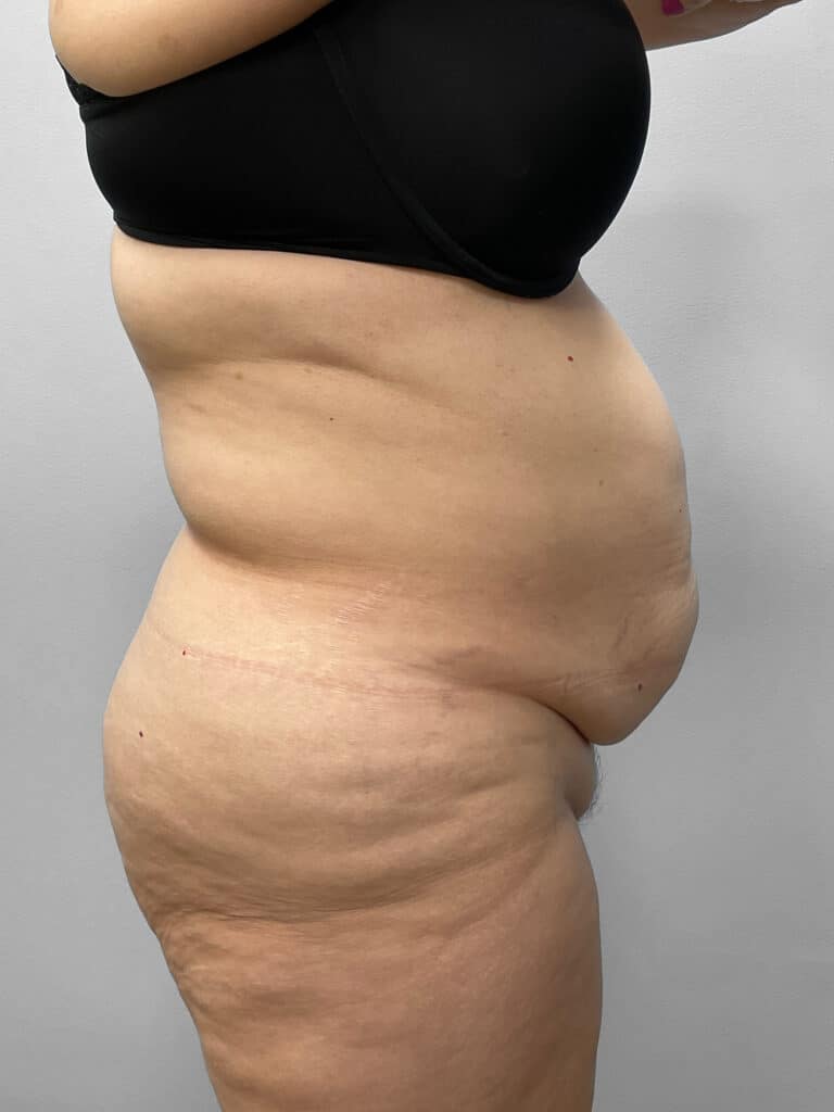 Before Image: Tummy Tuck & Liposuction- Dr. Tucker - right-side