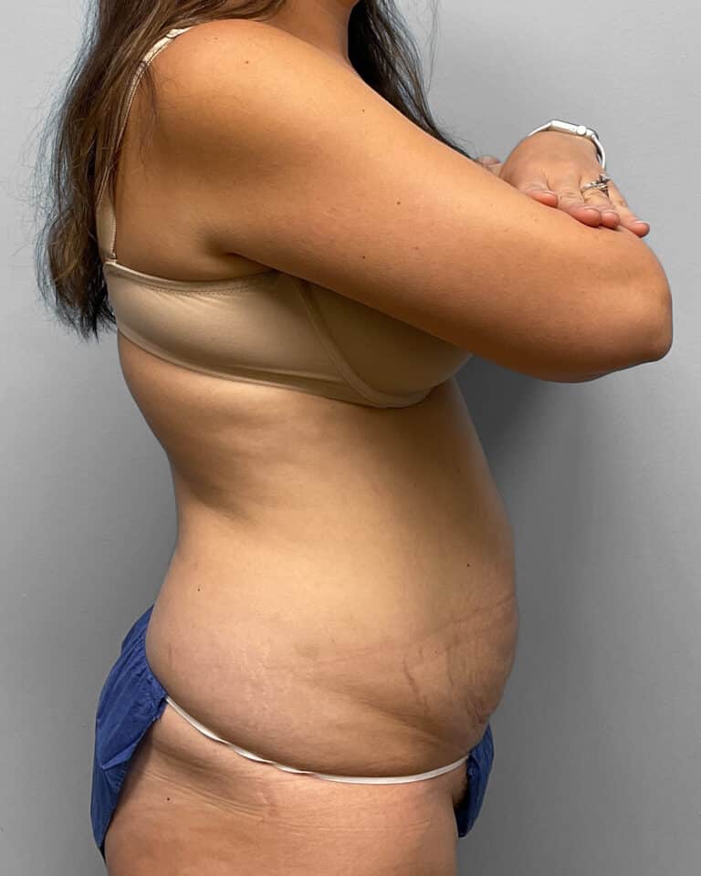 Before Image: Abdominoplasty- Dr. Tucker -