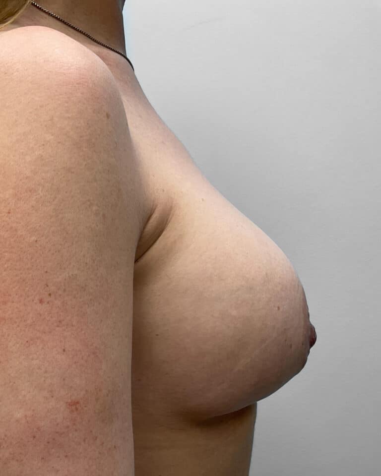 Before Image: Breast Augmentation- Dr. Tucker -