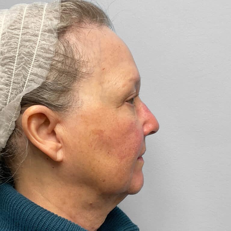 Before Image: Facelift & TFX- Dr. Tucker - right-side