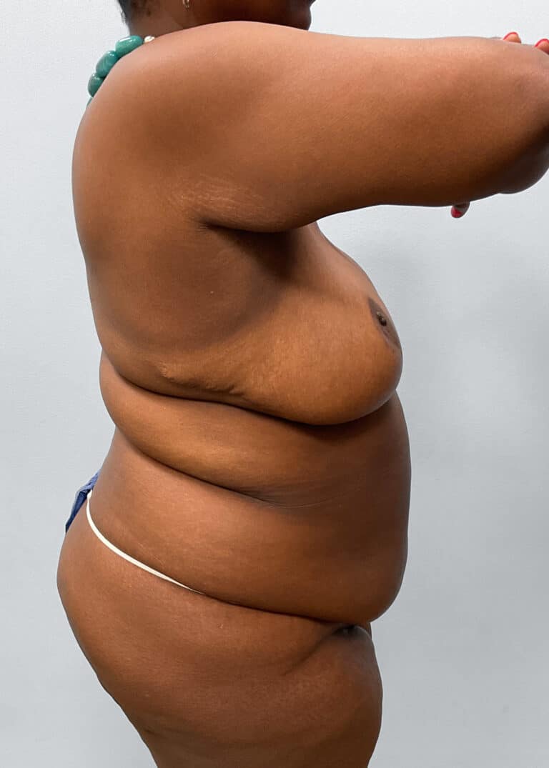Before Image: Tummy Tuck & Lipo- Dr. Tucker - right-side