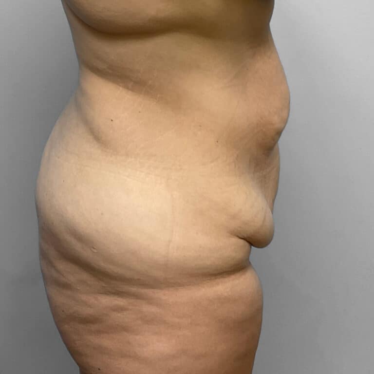 Before Image: Tummy Tuck & Lipo- Dr. Howell - front