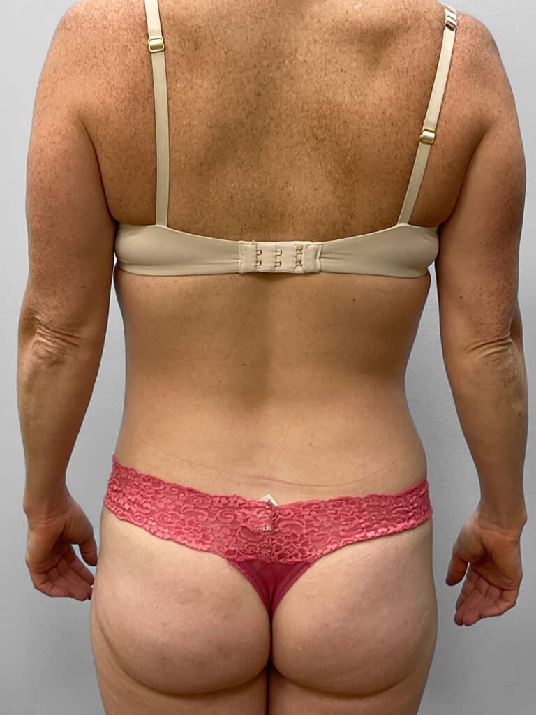 After Image: Liposuction- Dr. Howell - back