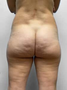 After Image: BBL, Thigh Lift & Lipo- Dr. Tucker