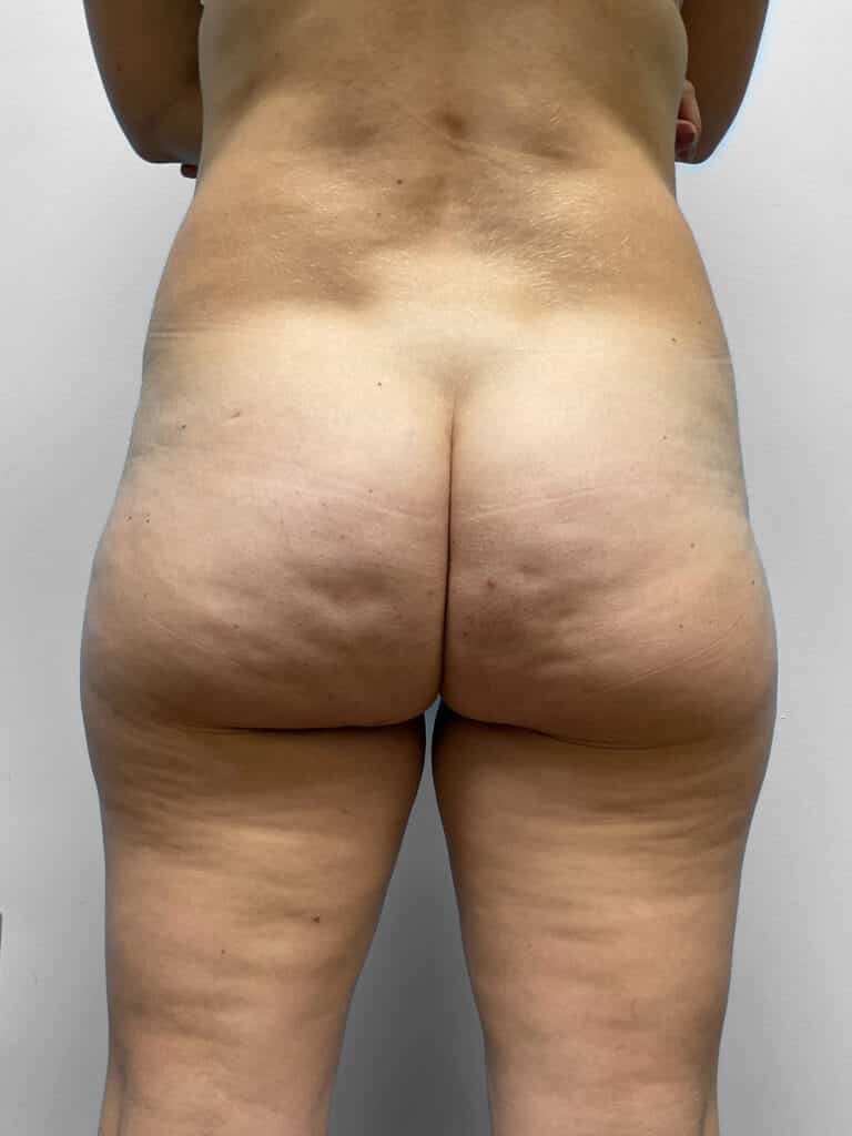 After Image: BBL, Thigh Lift & Lipo- Dr. Tucker - back