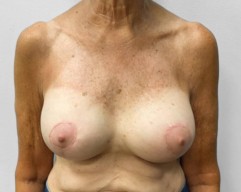 After Image: Breast Lift & Implant Exchange- Dr. Howell - front