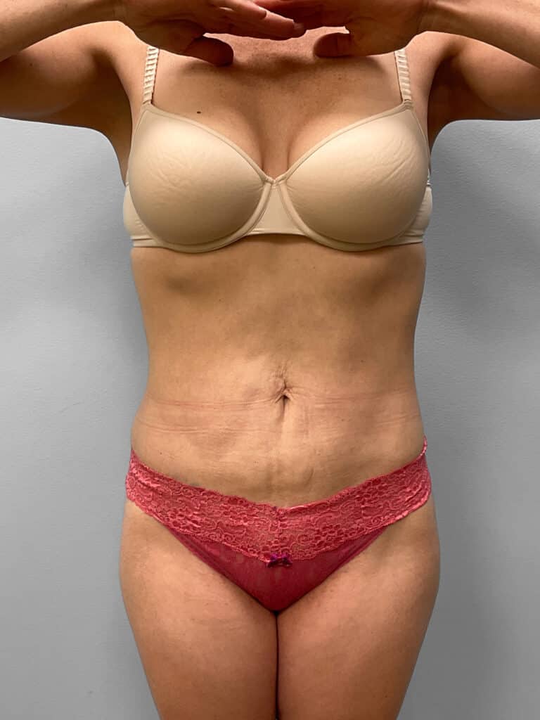 After Image: Liposuction- Dr. Howell - front