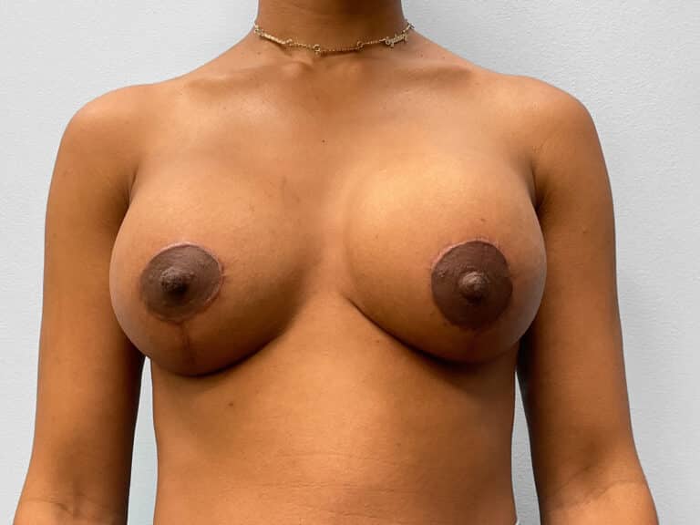 After Image: Breast Implant Revision- Dr. Howell - front
