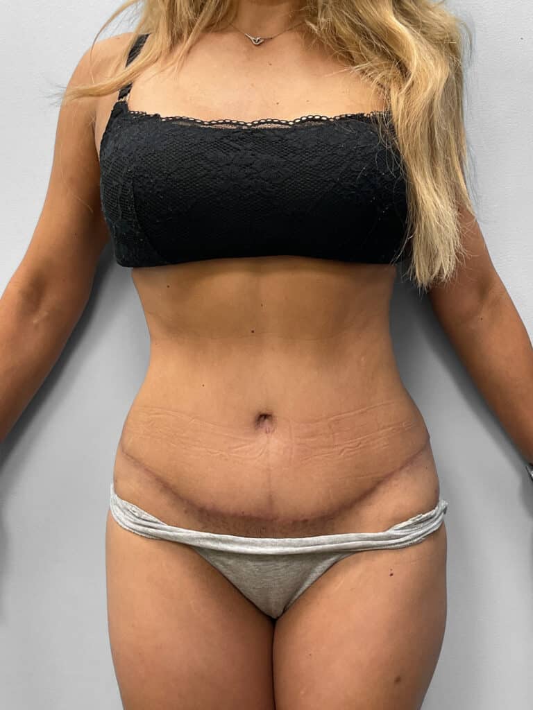 After Image: Tummy Tuck & Lipo- Dr. Howell - front
