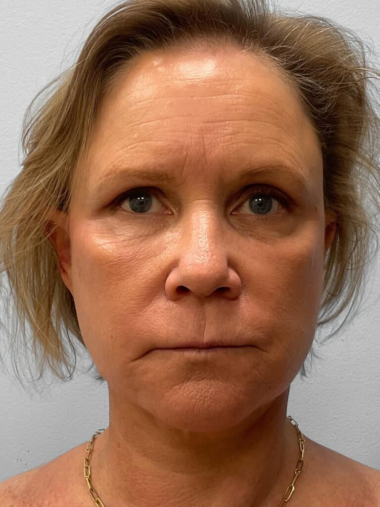 After Image: Facelift, Browlift, & Facial Rejuvenation- Dr. Howell - front