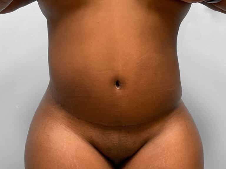 After Image: Abdominoplasty & 360 Liposuction- Dr. Tucker - front