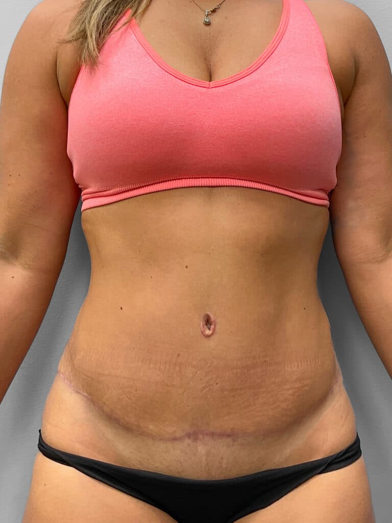 After Image: Tummy Tuck & Liposuction- Dr. Tucker - front