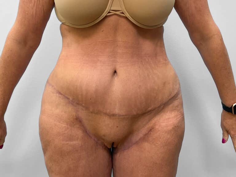 After Image: Abdominoplasty, Lipo & Thigh Lift- Dr. Tucker - front